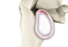 Labral Tear