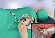 Arthroscopic Tennis Elbow Surgery