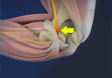 Cubital Tunnel Syndrome