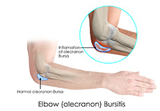 Elbow Bursitis