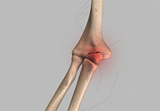 Elbow Fractures