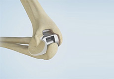 Elbow Joint Replacement