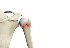 Humerus Fractures