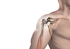 Revision Shoulder Arthroplasty