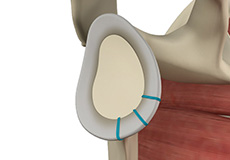 Shoulder Labrum Reconstruction/Labral Repair