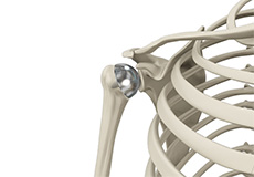 Biologic Shoulder Resurfacing