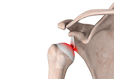 Shoulder Stabilization/ Labral Instability Repair