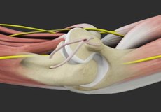 Medial Ulnar Collateral Ligament Reconstruction