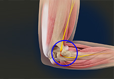 Ulnar Nerve Transposition