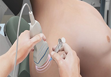 Ultrasound Guided Shoulder Injections
